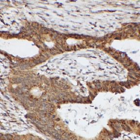 IHC_human lung cancer